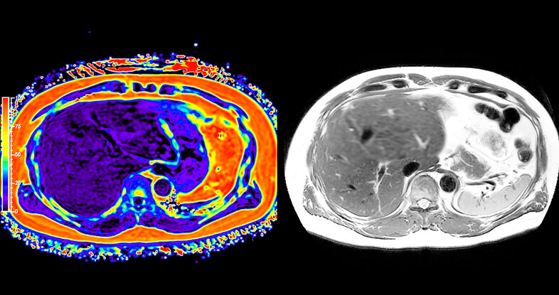 Ein MRI-PET-Scan des Abdomens in axialer Ansicht